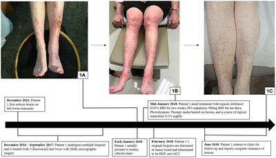 Case report: Hypertrophic lichen planus initially misdiagnosed as squamous cell carcinoma